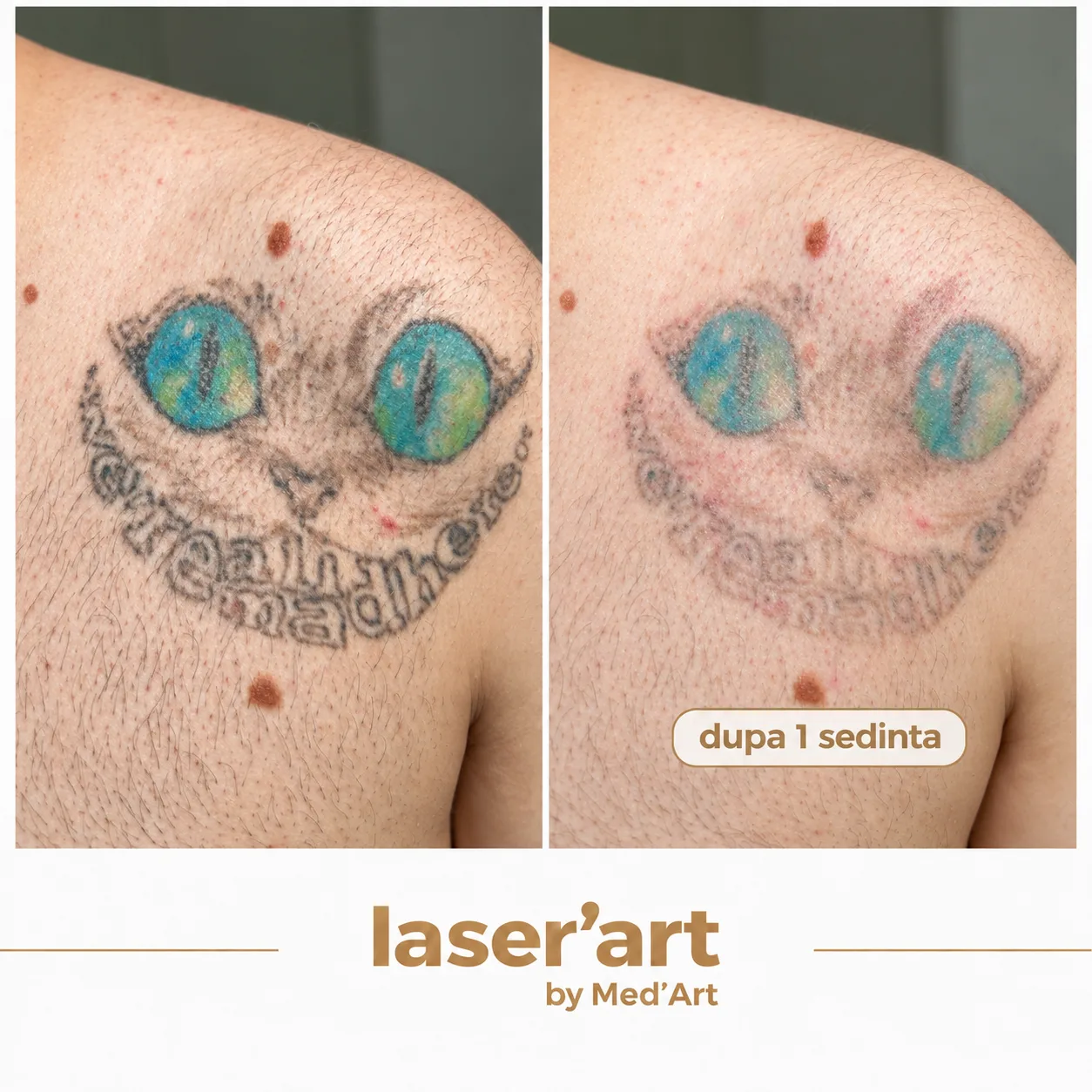 Indepartare tatuaje cluj - Laser'Art