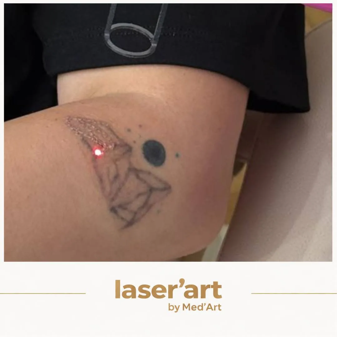 Indepartare tatuaje cluj - Laser'Art
