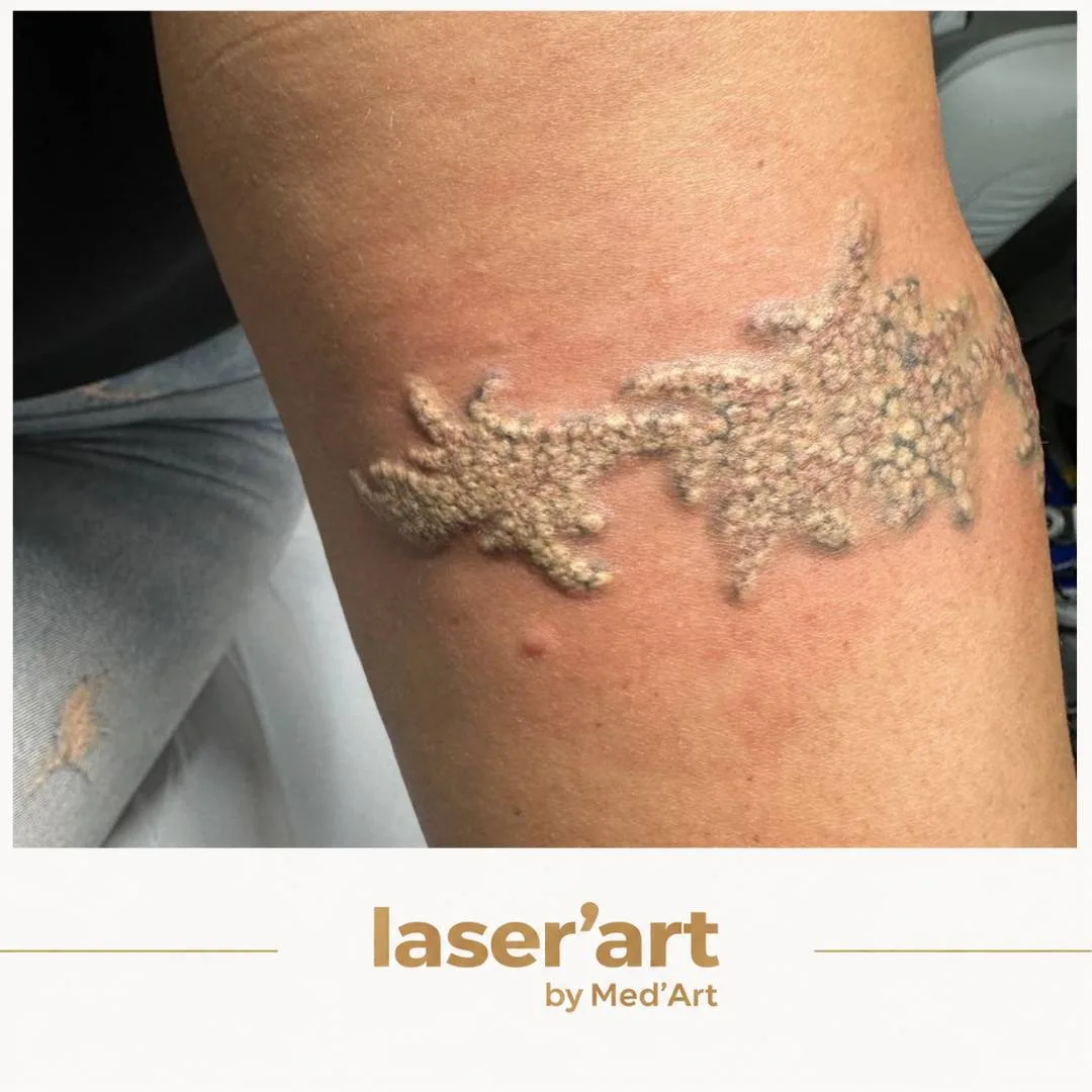 Indepartare tatuaje cluj - Laser'Art