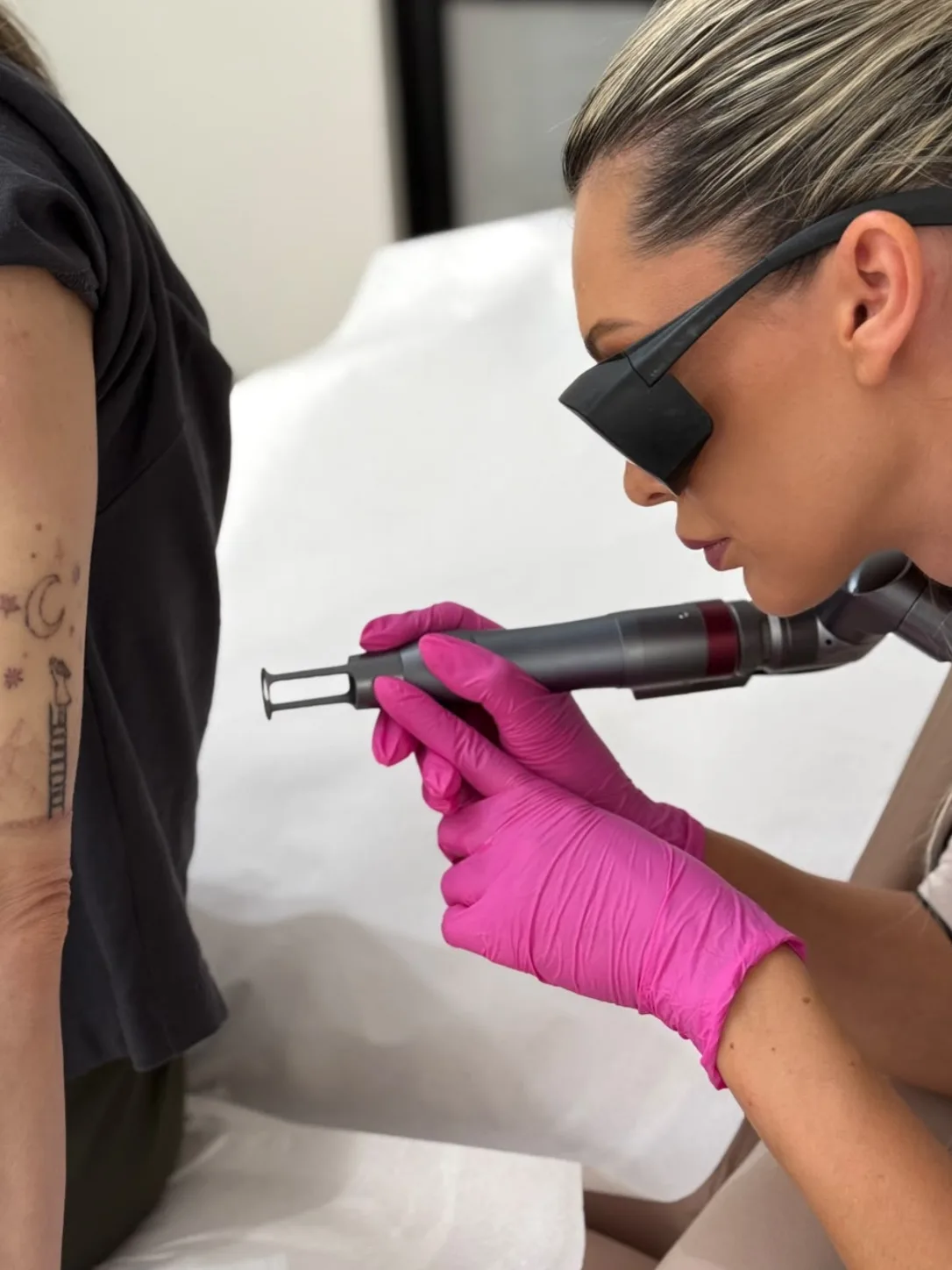 Indepartare tatuaje cluj