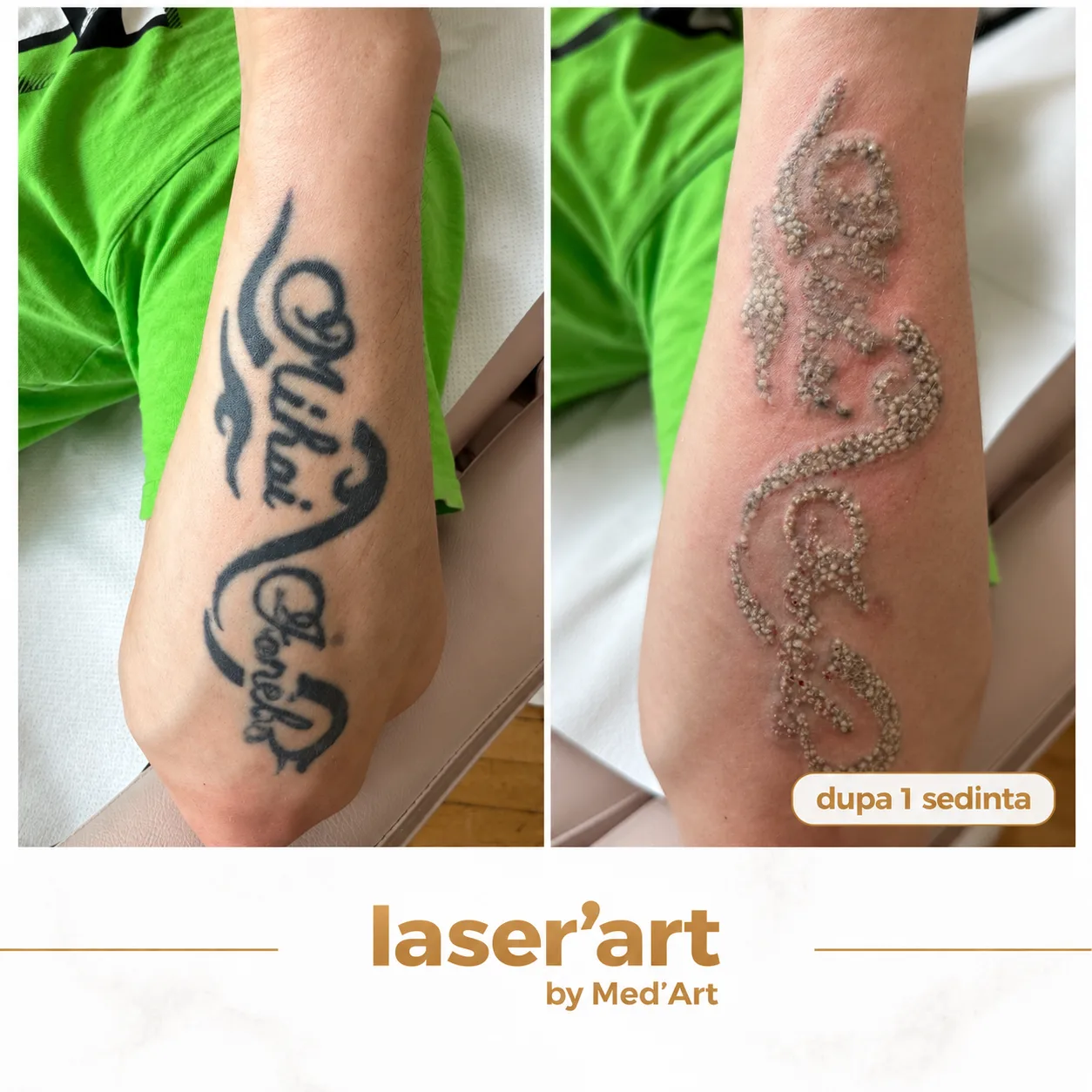 Indepartare tatuaje cluj - Laser'Art