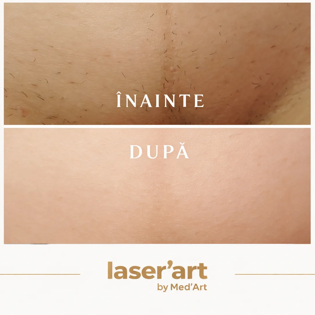 Epilare definitiva cluj - Laser'Art