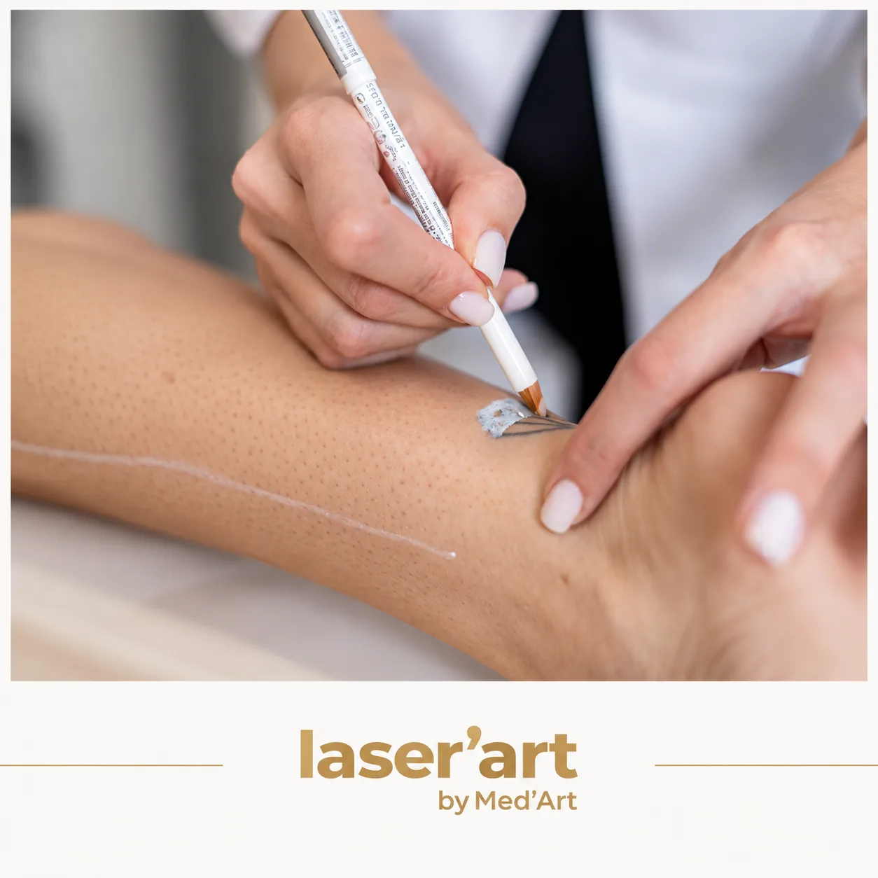 Epilare definitiva cluj - Laser'Art