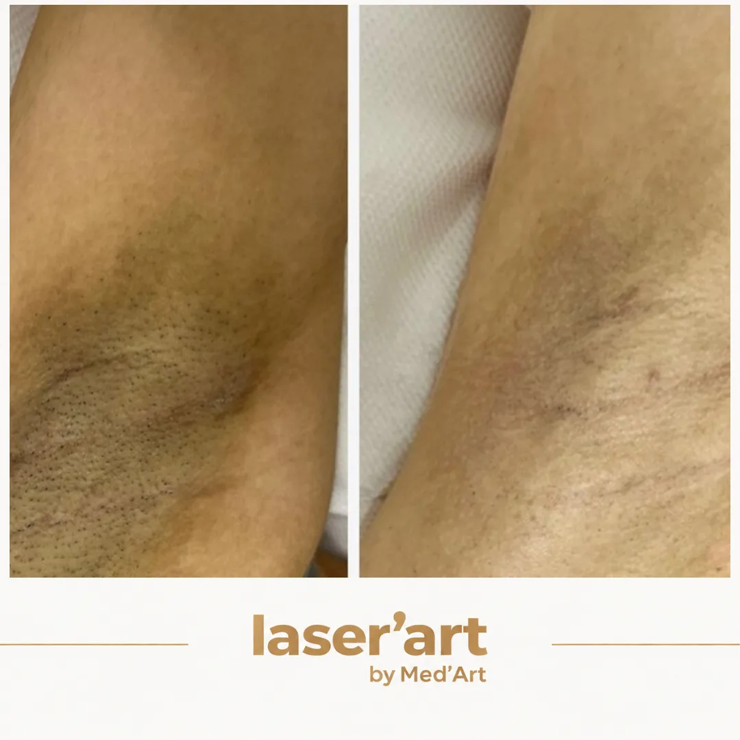 Epilare definitiva cluj - Laser'Art