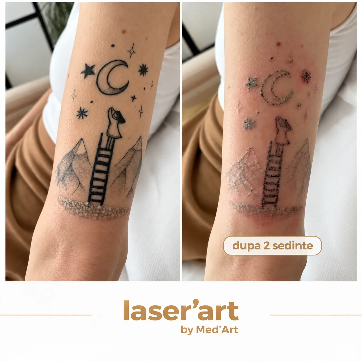Indepartare tatuaje cluj - Laser'Art