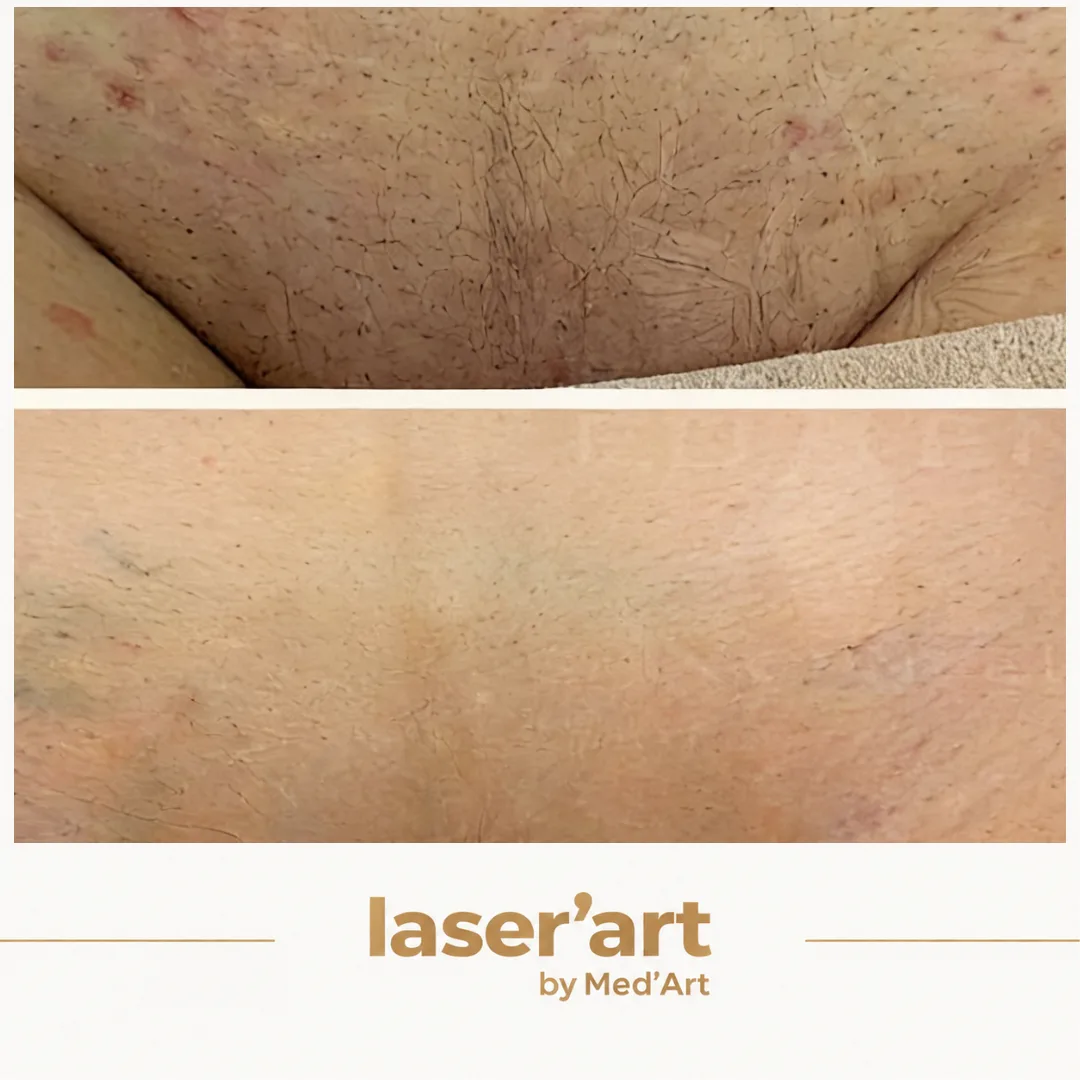 Epilare definitiva cluj - Laser'Art