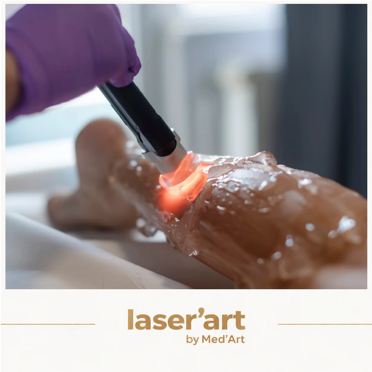 Epilare definitiva cluj - Laser'Art