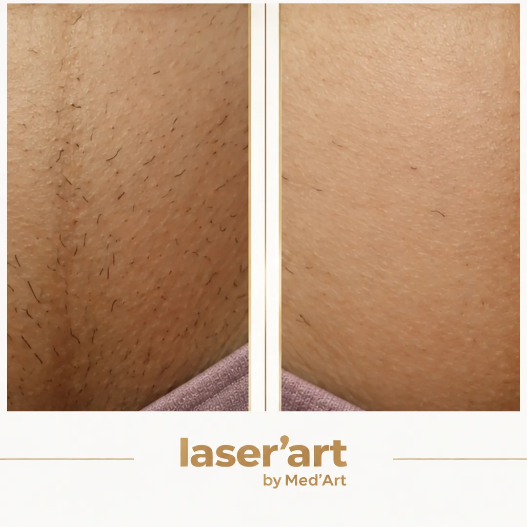 Epilare definitiva cluj - Laser'Art