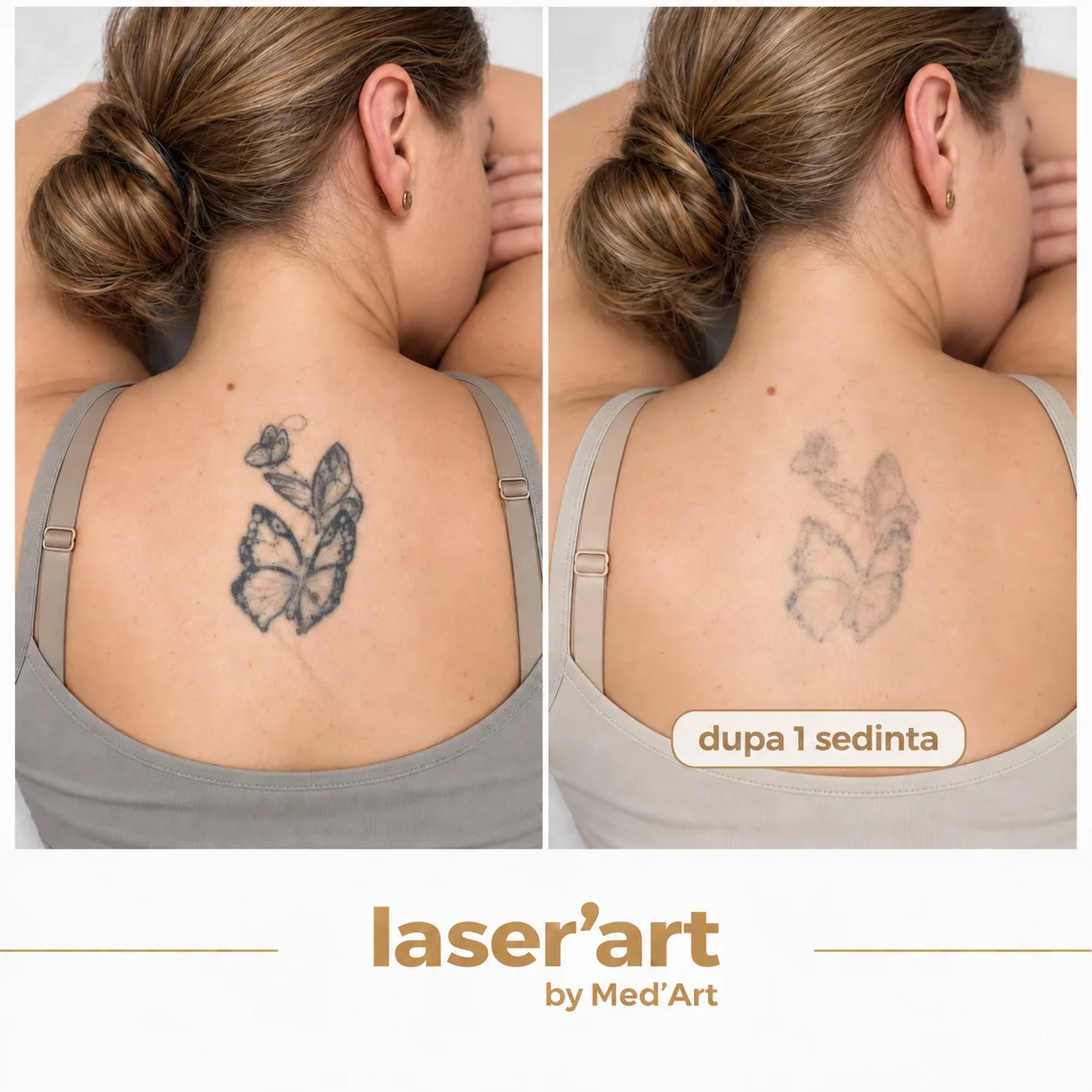 Indepartare tatuaje cluj - Laser'Art