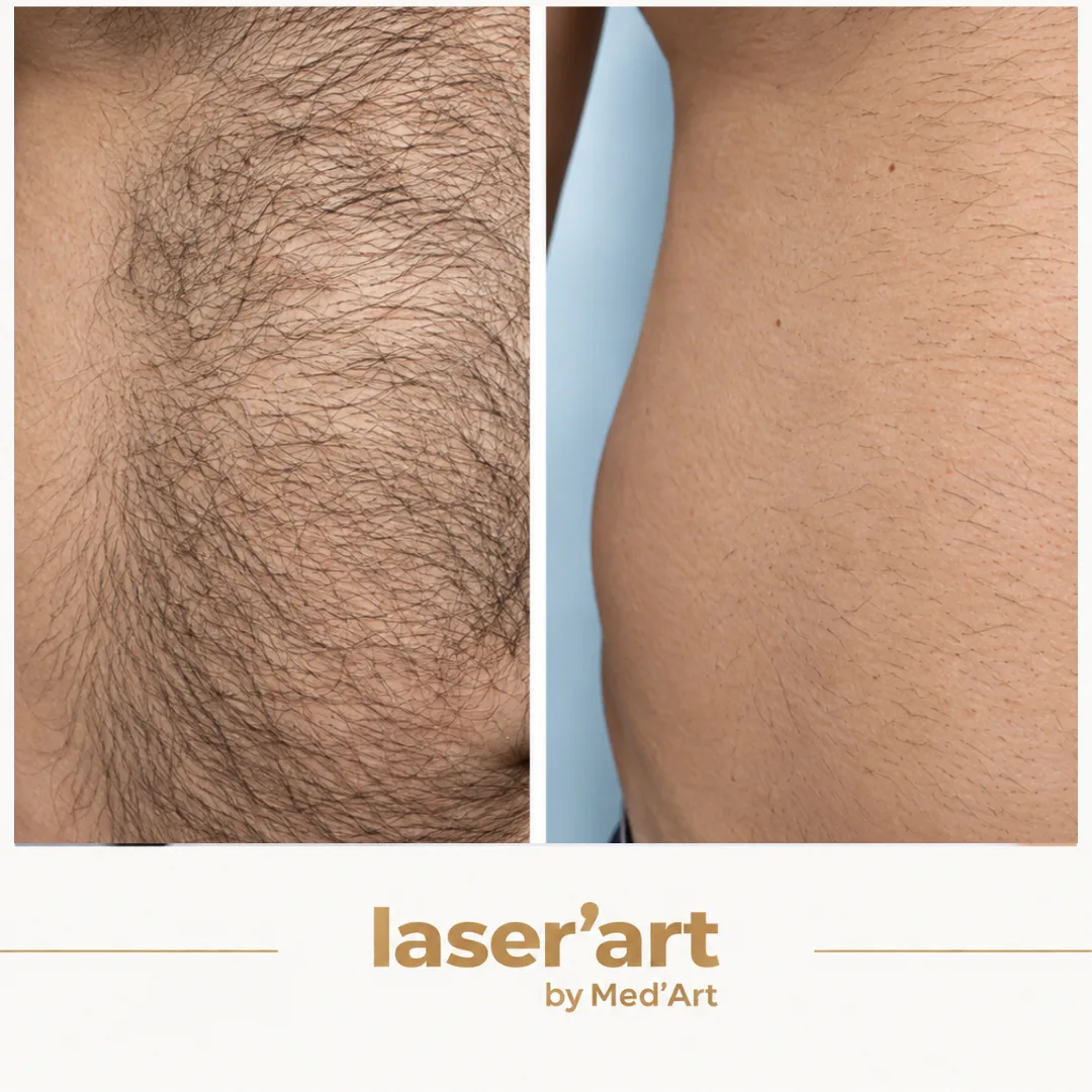 Epilare definitiva cluj - Laser'Art